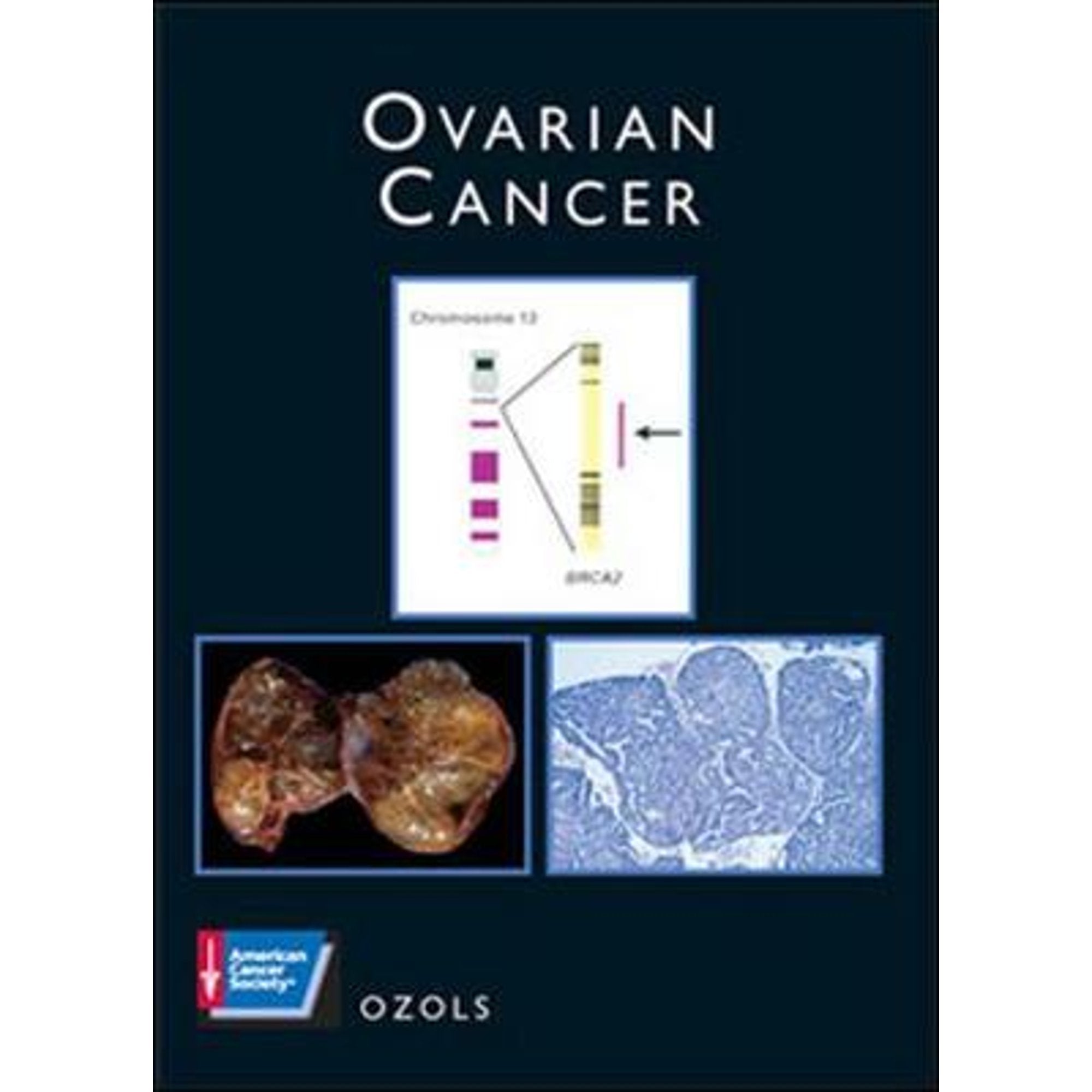 Ovarian Cancer: A Volume In The American Cancer Society Atlas Of Clinical Oncology Series